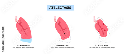 Atelectasis medical poster