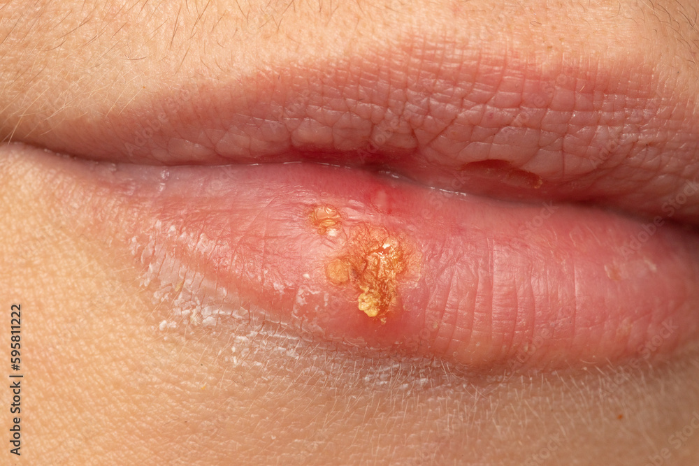 Fototapeta premium Macro of woman's lips with cold sores