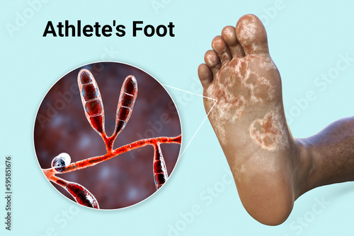 The foot with mycosis, and close-up view of fungi that cause Athlete's foot, 3d illustration photo