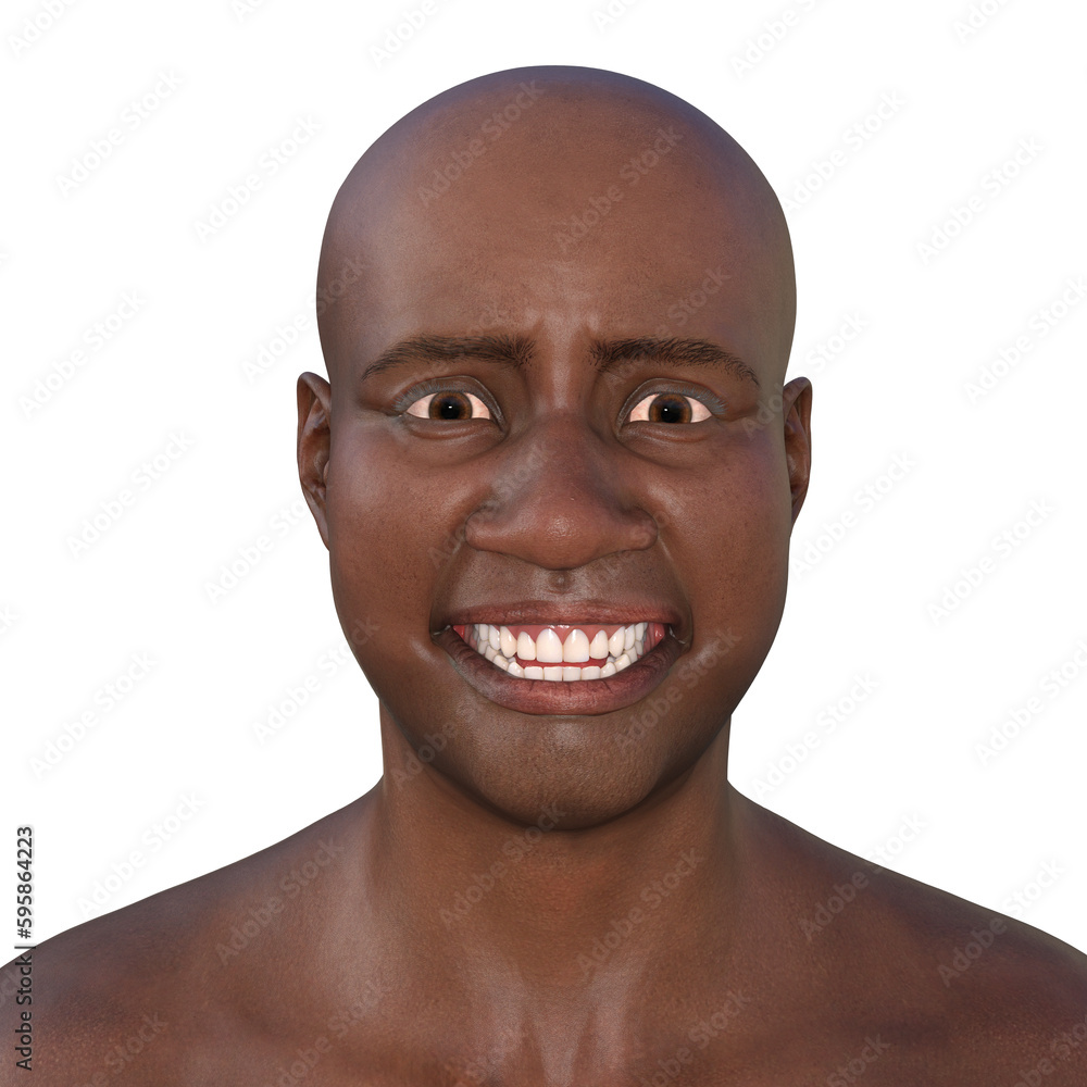 A 3D illustration depicting a person suffering from tetanus, shown with lockjaw symptom, also known as trismus A 3D illustration depicting a person suffering from tetanus, shown with lockjaw symptom, also known as trismus