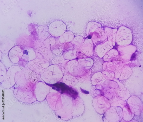 Microscopic analysis showing Epidermal inclusion cyst, swelling of left thigh photo
