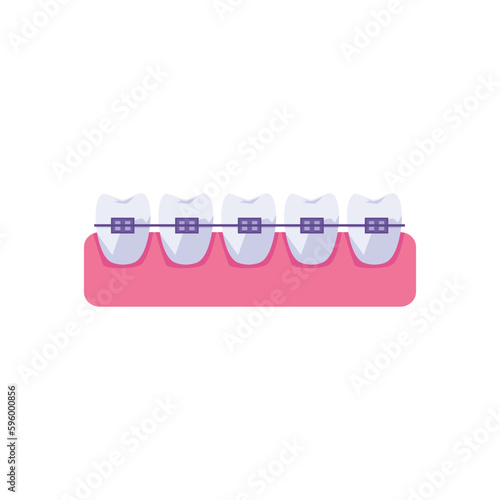 Row of teeth with metal braces flat style, vector illustration