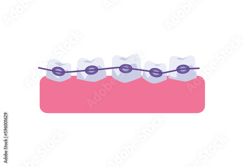 Jaw with teeth in orthodontic braces flat vector illustration isolated on white.