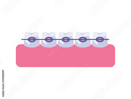 Row of teeth with metal braces flat style, vector illustration