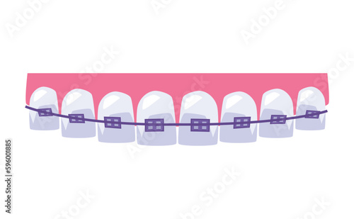 Teeth straightening with purple dental braces, flat vector illustration isolated on white background.