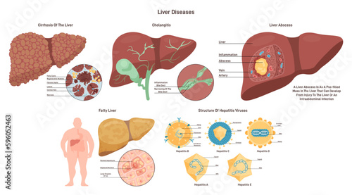 Liver diseases set. Hepatic system organ pathology. Liver damage photo