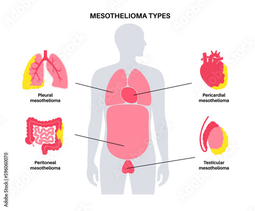 Mesothelioma tumor types