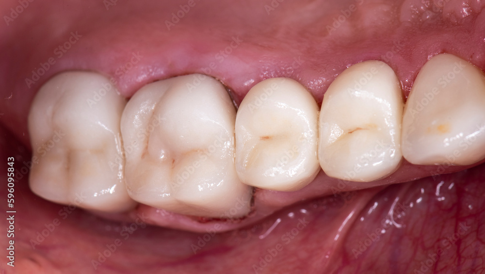 Obraz premium Emax ceramic crowns and veneers like natural teeth
