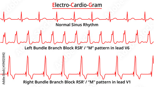 Set of ECG Common Abnormalities - Left Bundle Branch Block vs Right Bundle Branch Block - Normal Sinus Rhythm - Medical Vector Illustration