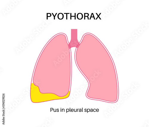 Pyothorax pleural empyema photo