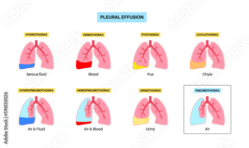 Pleural effusion poster