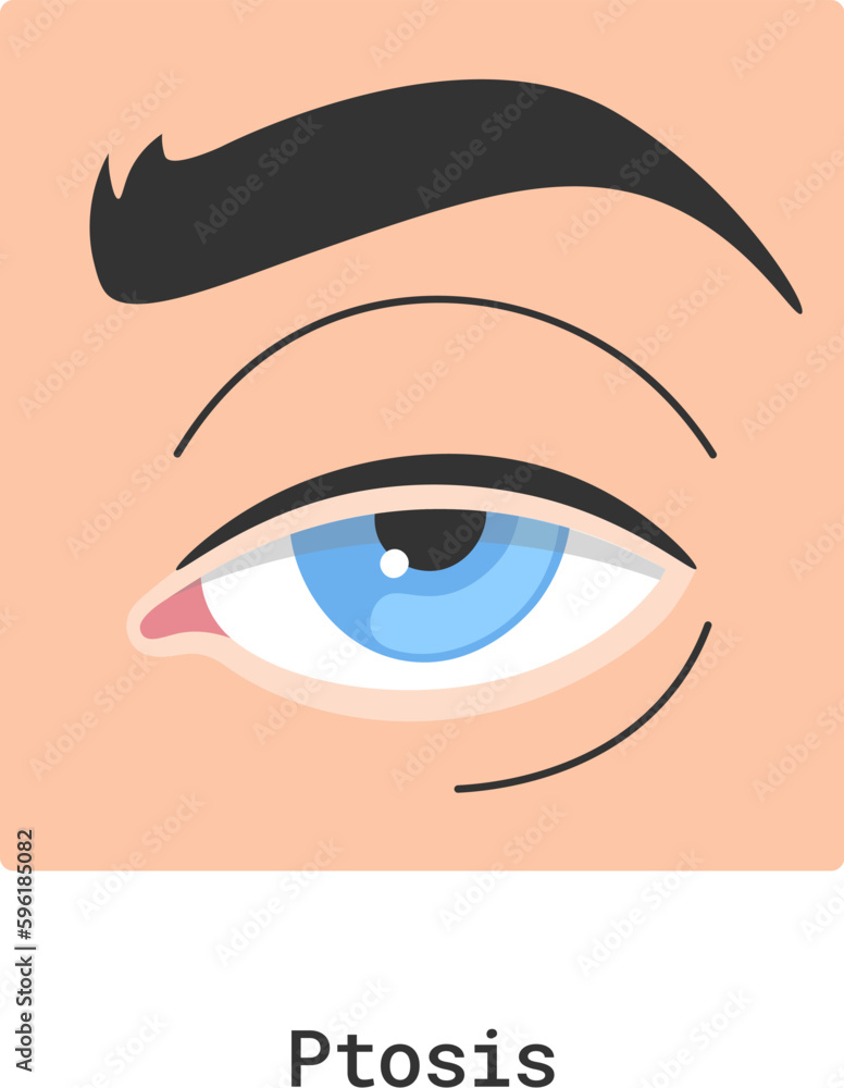 Ptosis Human Eye Disease Ptosis Human Eye Disease