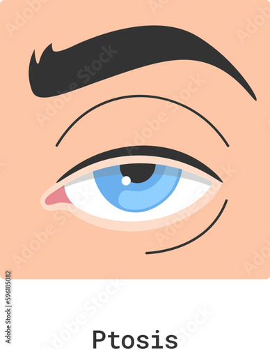 Ptosis Human Eye Disease