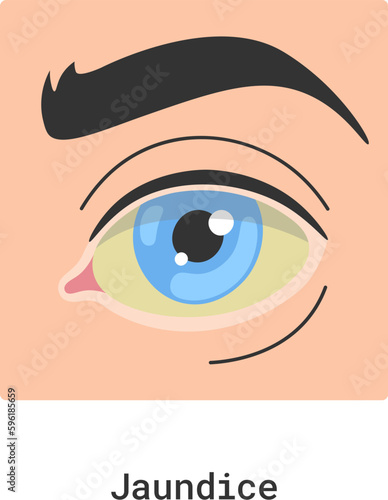Jaundice Human Eye Disease