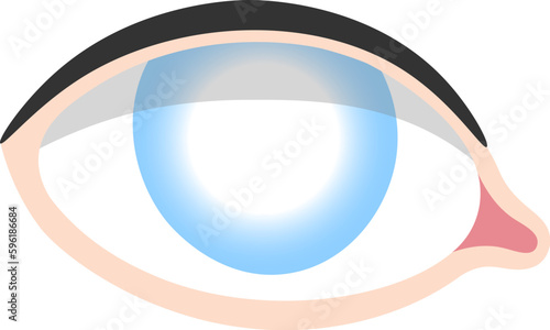 Cataract Human Eye Disease