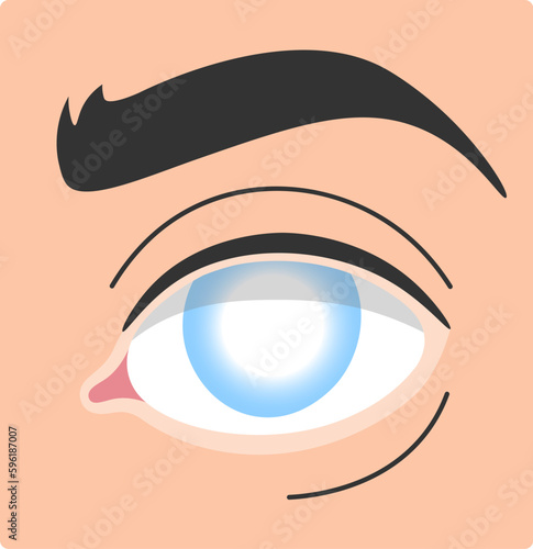 Cataract Human Eye Disease