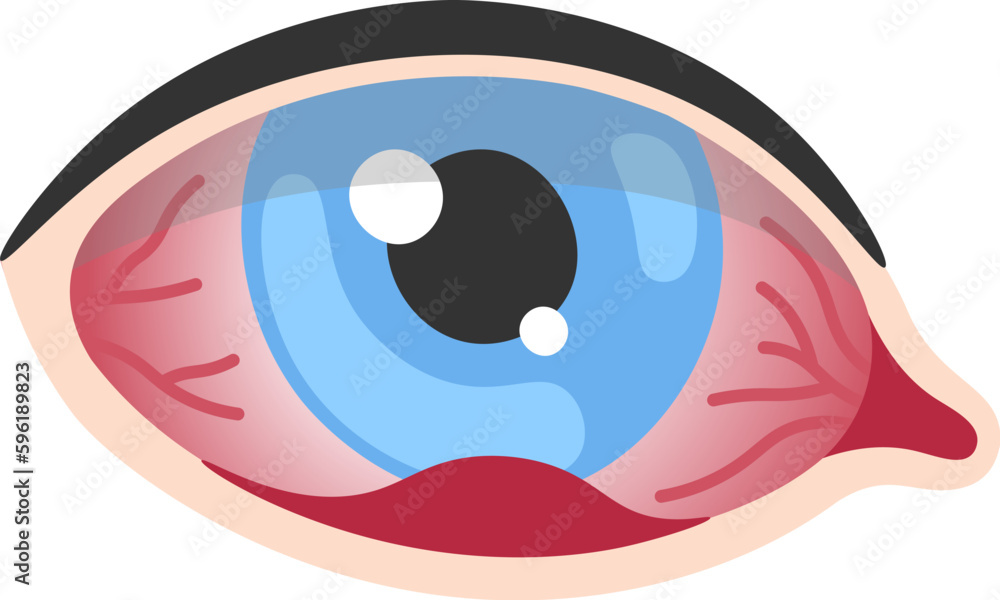 Fototapeta premium Stye Human Eye Disease