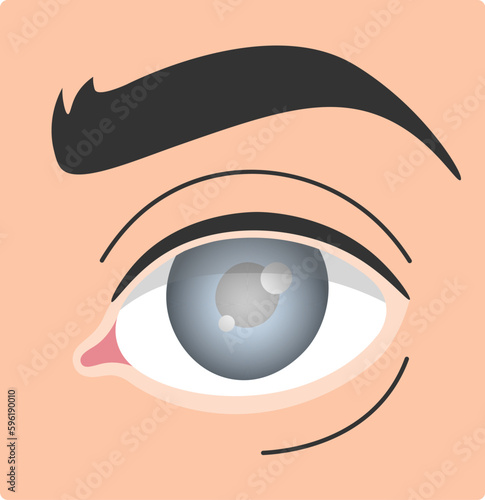 Glaucoma Human Eye Disease