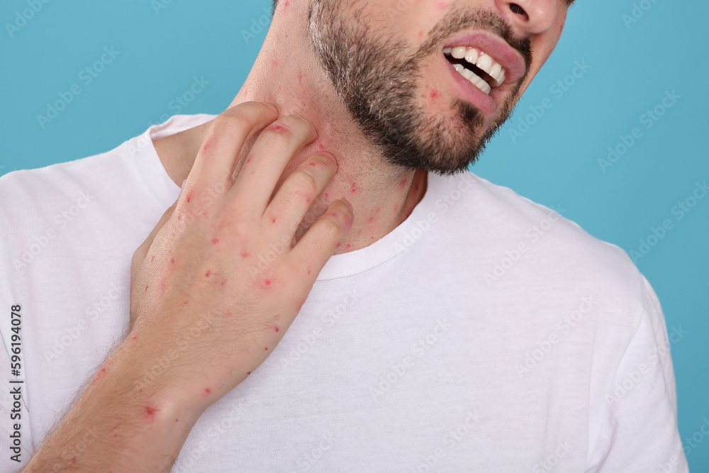 Obraz premium Man with rash suffering from monkeypox virus on light blue background, closeup