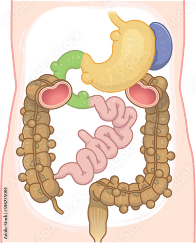 大腸憩室・憩室穿孔・憩室・Diverticulum・メッケル憩室・メッケル憩室癌のイラスト