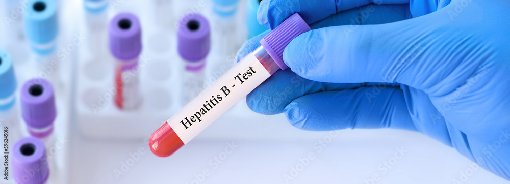 Naklejka premium The doctor holds a test blood sample tube with hepatitis B virus (HBV) test on the background of medical test tubes