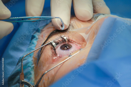 ophthalmology eye surgery excimer laser