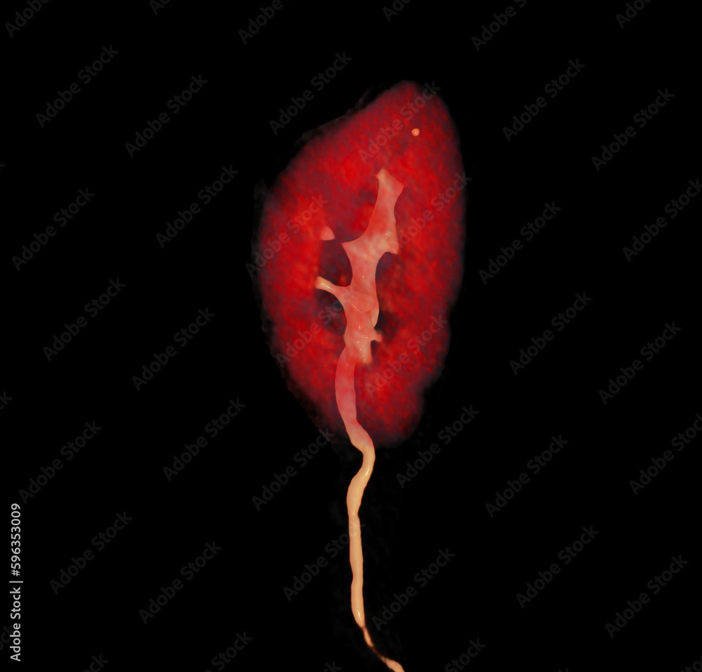 CTA Renal artery showing kidney 3D rendering image. CTA Renal artery showing kidney 3D rendering image.