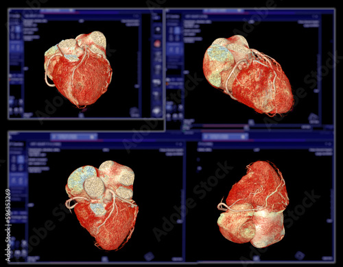 CTA Coronary artery  3D rendering image.