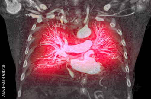 CTA pulmonary arteries 3D rendering showing branch of pulmonary artery