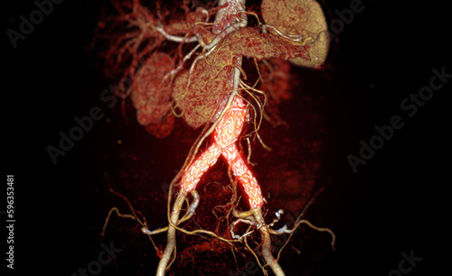 CTA of the aorta with stent-grafting in patient Abdominal aortic aneurysm. photo
