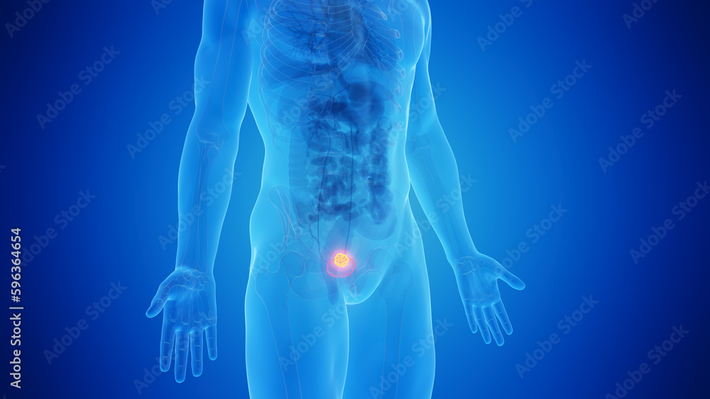 3D Rendered Medical Illustration of Urinary Bladder Cancer.