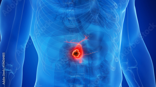 3D rendered Medical Illustration of Male Anatomy - gallbladder Cancer. photo