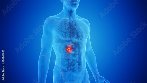 3D rendered Medical Illustration of Male Anatomy - gallbladder Cancer.