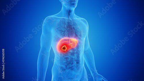 3D Rendered Medical Illustration of Male Anatomy - liver cancer photo