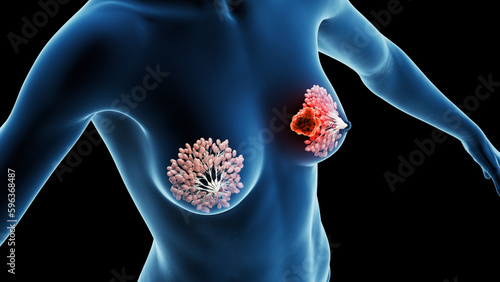 3d rendered medical illustration of breast cancer photo