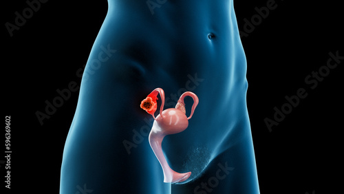 3d medical illustration of ovarian cancer photo