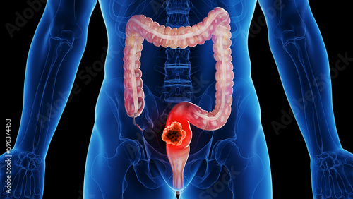 Foto 3d rendered medical illustration of rectal cancer