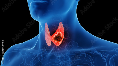 3d rendered medical illustration of thyroid cancer