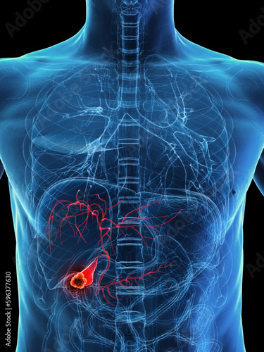 3D rendered Medical Illustration of Male Anatomy - gallbladder Cancer. photo