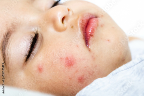 Face of a child with the virus that causes hand-foot-and-mouth disease, a contagious syndrome caused by the Coxsackie A16 virus of the enterovirus family that inhabits the digestive system.