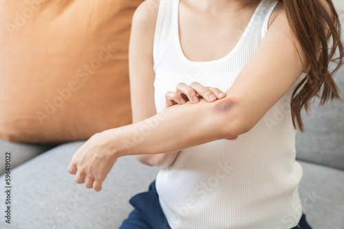 Wallpaper Mural Close up of stain bruise wound on arm, contusion asian young woman, girl an accident fell down stairs, hand on elbow in healing injury by massage hematoma blood. Extravasation blue, purple on skin. Torontodigital.ca