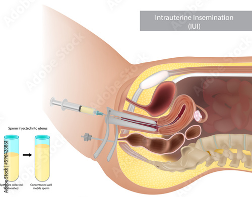 Schematic illustration artificial insemination. Intrauterine insemination IUI. Sperm injected into uterus