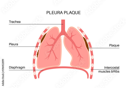 Pleural plaque poster