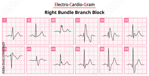 Right Bundle Branch Block - The Differences in ECG Waveform for Each of the 12 Leads - Medical Vector and Illustration