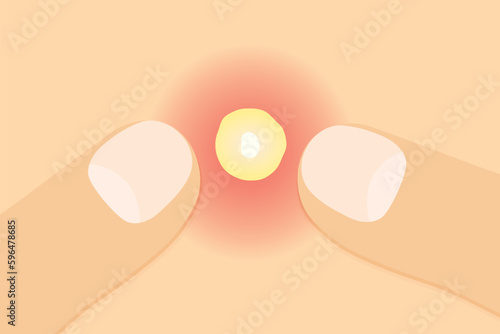 fingers squeezing a pimple- vector illustration