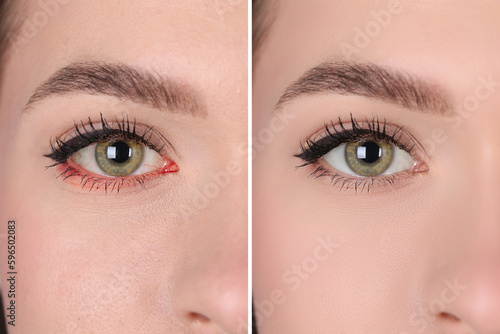 Collage with photos of woman before and after conjunctivitis treatment, closeup of eye photo