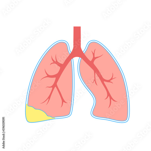 Pyothorax pleural empyema