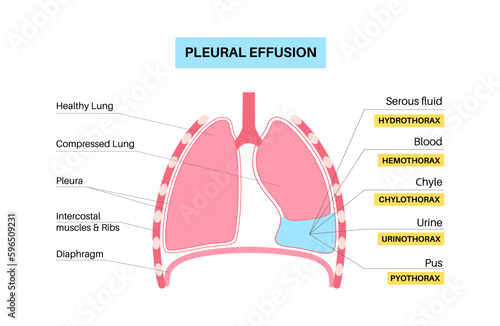 Pleural effusion poster photo