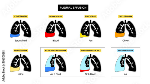 Pleural effusion poster