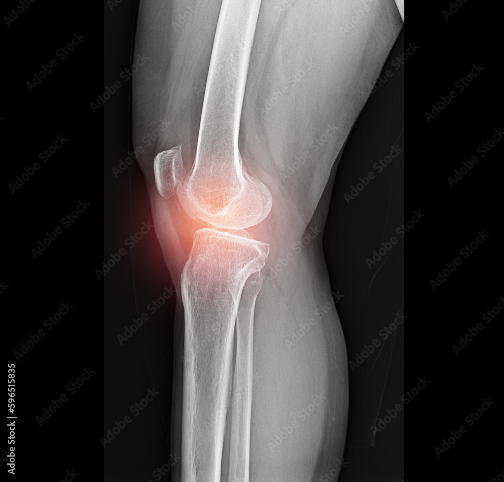Fototapeta premium Inflamed knee joints, pain, x-ray images